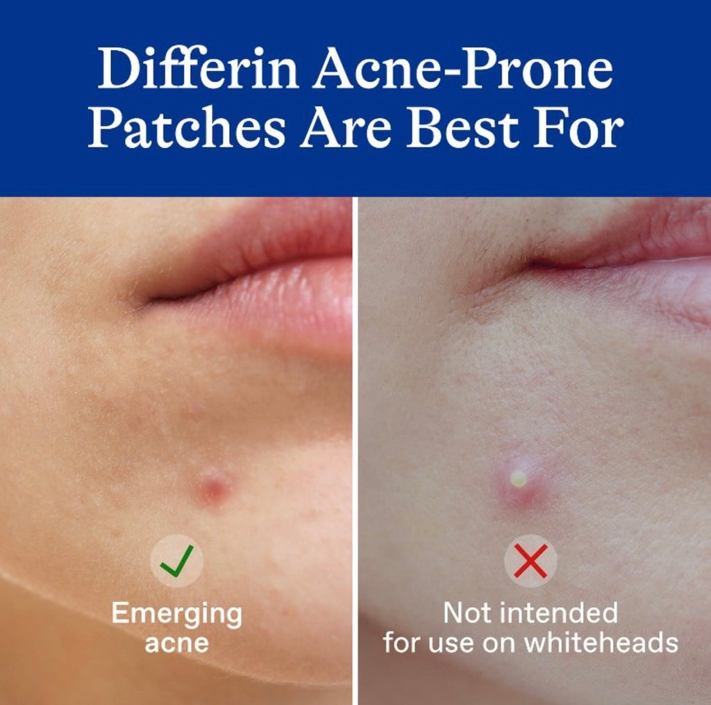 Differin Fast Fix Salicylic Acid Pimple Patches for Emerging Acne